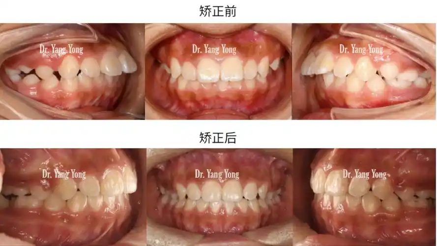 矫正前后口内像对比