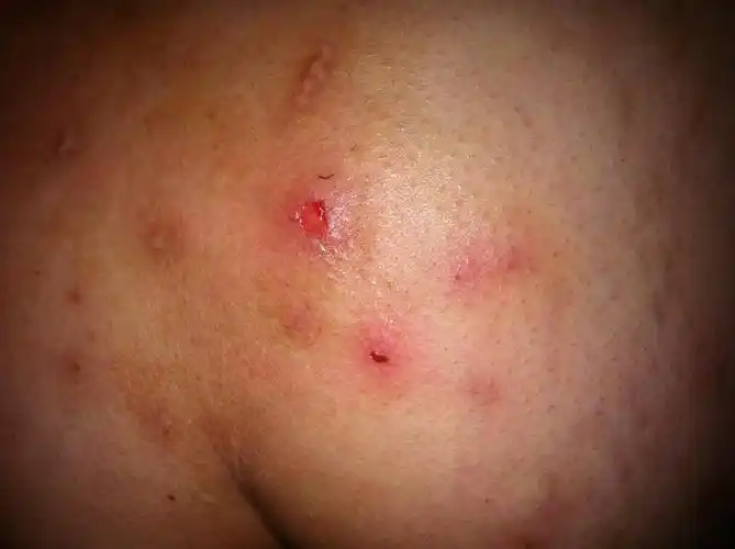 这个是毛囊炎么