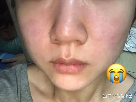 敏感肌肤日常如何护肤敏感肌肤该怎么修复