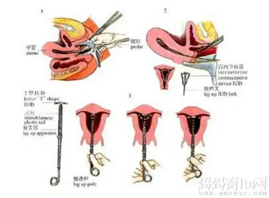上环疼不疼-请牢记上环的四种情况-梦想生活,圆满生活,生活网