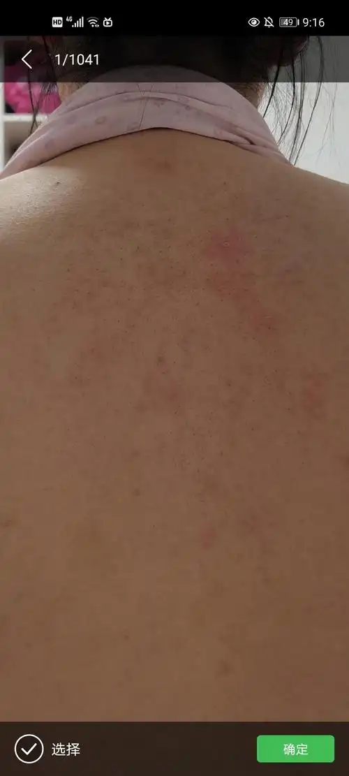 我的背上有很多黑头该怎么办啊慎入