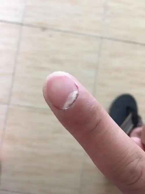 医生您好我的右手食指指甲根部的皮起来了好几周了一直没有