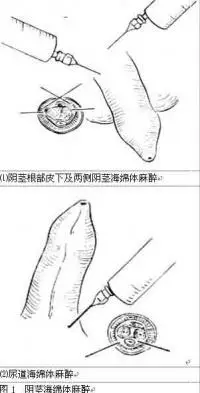 包皮环切步骤示意图1⑴用止血钳夹起背侧包皮 ⑵用有槽探针剥离包皮