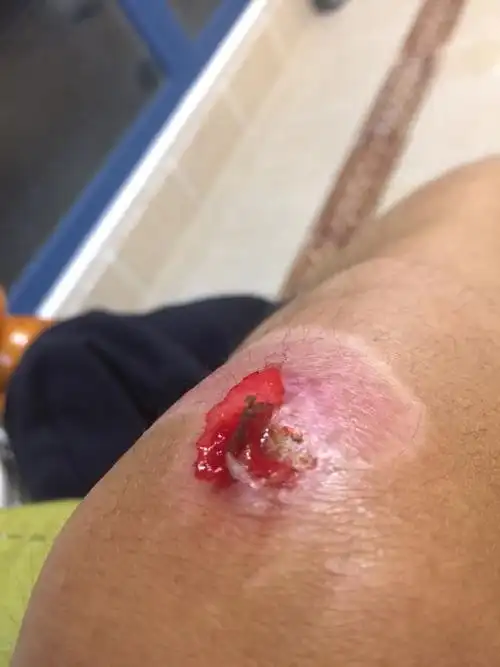 膝盖 伤口怎么处理