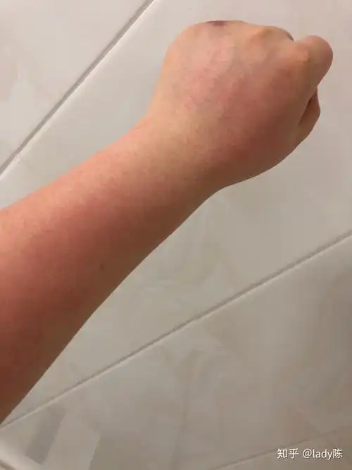 晚上虾过敏是什么感受?