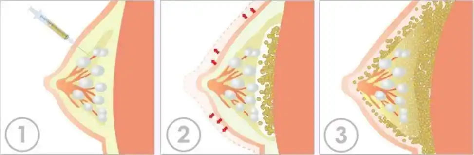 经期可以做自体脂肪丰胸手术吗