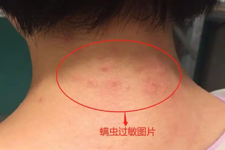 螨虫过敏最多见的临床表现为过敏性或虫咬皮炎,肌肤出现红斑或红疹