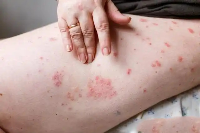 银屑病的症状的图片_银屑病求医网