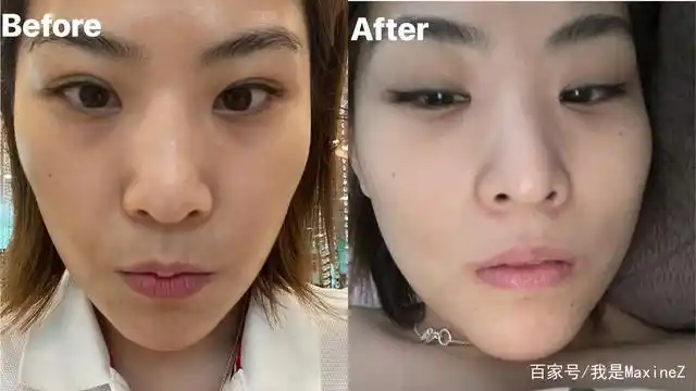 果酸换肤治疗前后对比图