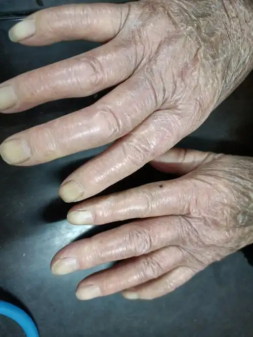 干燥综合征雷诺症 - 好大夫在线