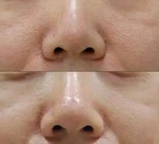 鼻翼两侧毛孔如何收缩 鼻子周围毛孔粗大 什么原因造成的呢 有什么