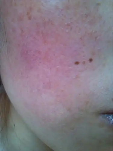 用新的护肤品后十天,脸上严重过敏,怎么办