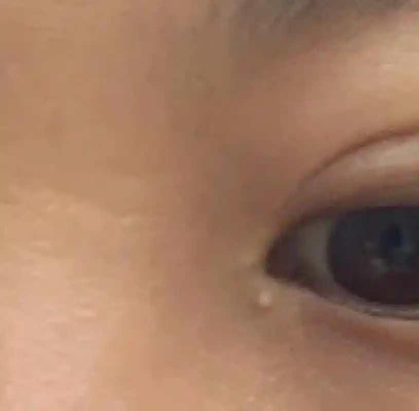 眼角小疙瘩94 最近半年发现眼角长了个小疙瘩 看起来像眼shi93 在