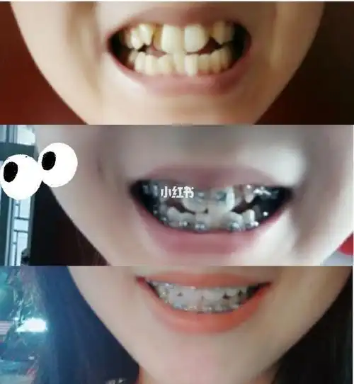 一年两个月摆脱严重龅07不齐虎牙