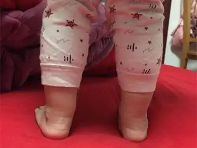 三岁小孩内八字走路x型腿怎么矫正