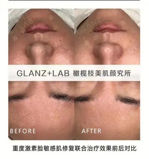 敏感肌  #重度激素脸  #皮肤屏障修复  一次效果前后对比