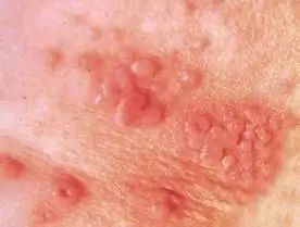 女性梅毒潜伏期的图片介绍