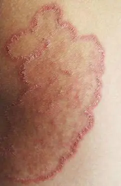 股癣和湿疹的区别图片