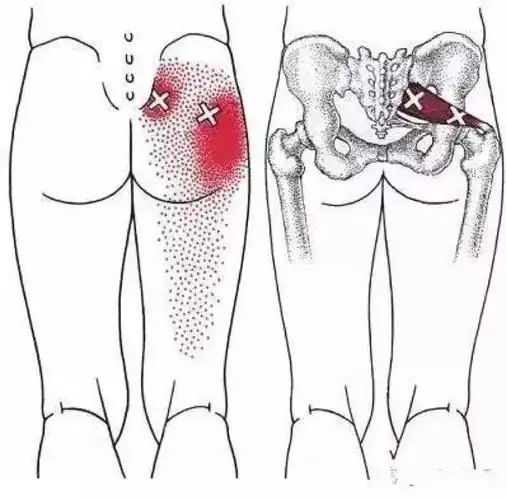 臀部大腿根疼有可能是它出了问题
