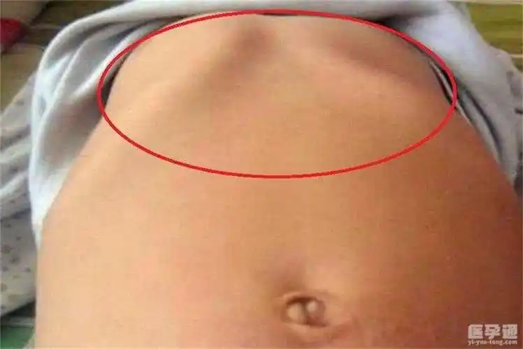 婴儿佝偻病睡姿图片分享按图对比又快速又准确