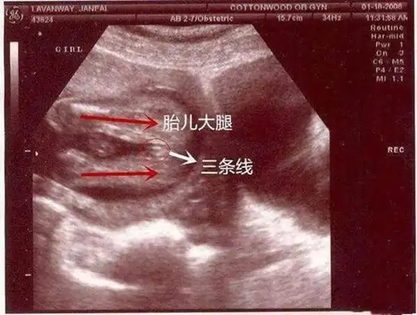 女宝b超双腿间有个圆球b超看男女揭秘