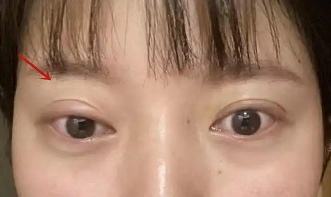 眼睑下垂大约多少钱(做上睑下垂矫正手术是一种什么体验呢) - 羊城网