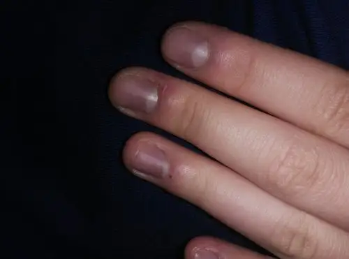 指甲最近变紫是不是有问题.