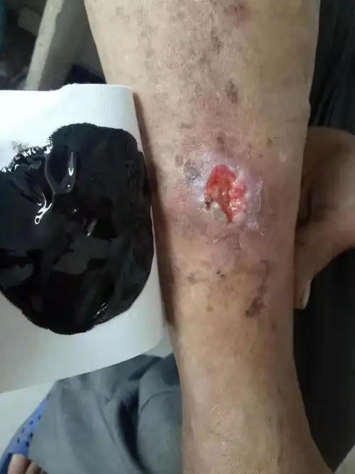 皮肤溃烂和皮肤溃疡的区别