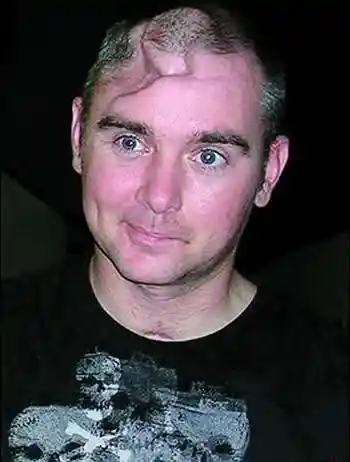 盘点头部中枪大难不死的人(组图)