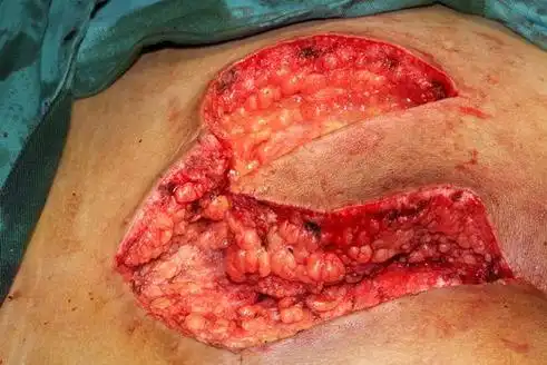 的部位,病灶有时边界不清,囊壁残留容易复发,所以需要彻底的手术切除