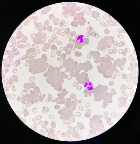 血涂片镜检:可见大量红细胞凝集.