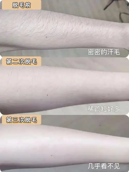 我花2w全身脱毛效果居然输给每天2毛的脱毛膏