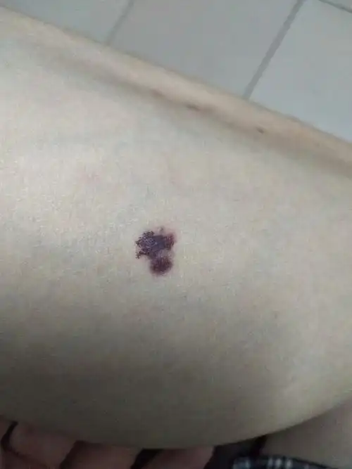 这几天小腿上长了一小块紫红色的痣不知道怎么回事
