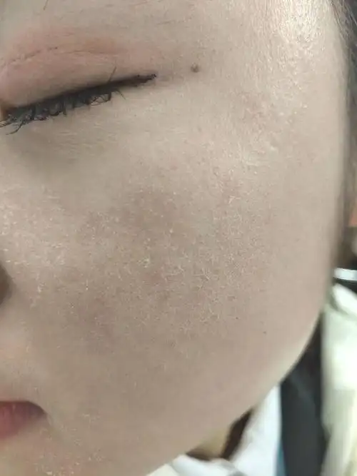 脸上脱皮,有刺痛感,灼伤感,求医生解答!