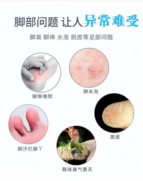 乳膏去脚气脚臭汗脚痒喷剂治脚脱皮烂脚丫水泡糜烂开裂克星香港脚软膏