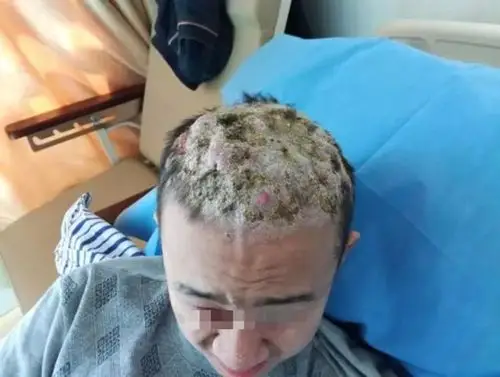 16岁少年蝼蛄疖爬满头医生提醒皮肤痤疮应及早治疗