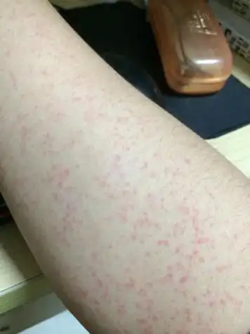 如何治严重皮肤过敏