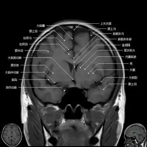 磁共振可进行横断面,冠状面,矢状面以及任意面的直接采集成像,可以多