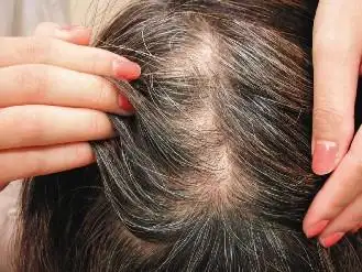 台女子用"天然"染发剂 致头发脱落变秃(图)