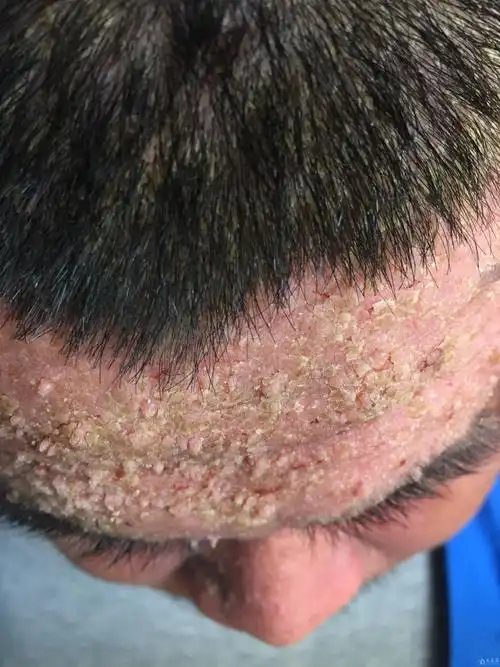 三甲医院无法确诊头面部皮肤病,大家来看看是什么 - 皮肤及性传播疾病