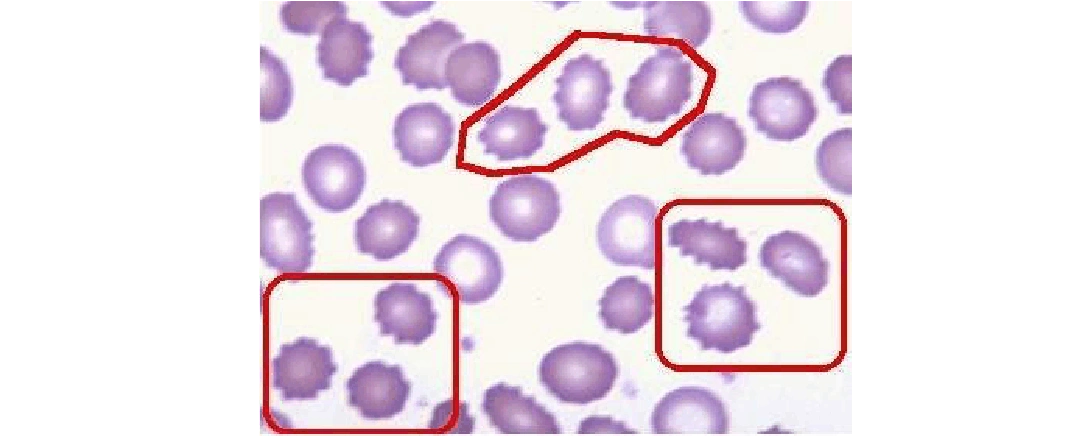 无忧文档 所有分类 血液细胞图谱ppt 刺毛红细胞 亦称锯凿细胞.