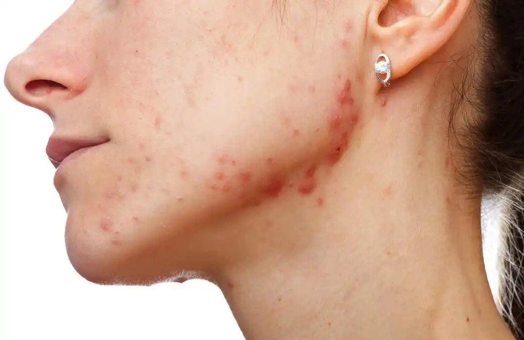 酒精真的可以消灭痘痘吗?