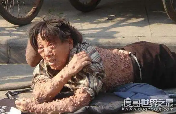 本篇文章图片过于恶心,如果你还想继续往下面看,请最好是有3天不吃饭