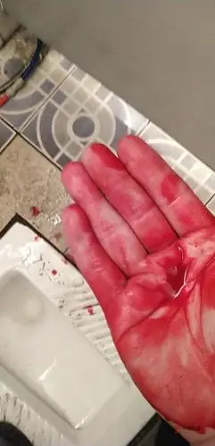 本来就饿的头晕眼花,居然还流血流鼻血.