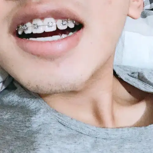 虎牙这么突出能矫正吗? - 知乎