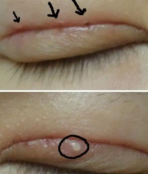 请问双眼皮330号拆线后出现像上火长