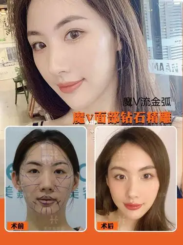 面部脂肪填充案例分享