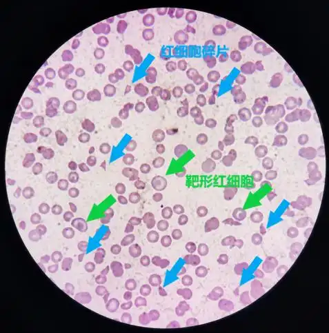镜下结果血小板与网织红细胞通道结果基本一致,镜下还可见大量的细胞