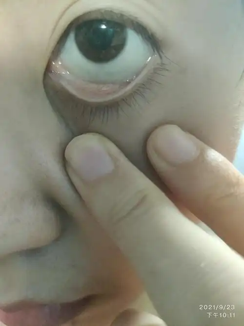 右眼眼睛内眼角黏膜红彤彤的,下眼皮内侧长了一组排列整齐的"痘痘",求