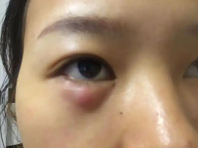 有没有医生啊,或者长过这玩意的,差不多一个月了,去医院医生说是囊肿